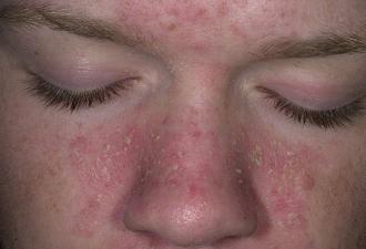 ¿Cómo deshacerse del enrojecimiento y la descamación de la piel en la cara?