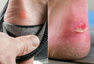 How to get rid of calluses on feet: home and pharmacy remedies, professional methods